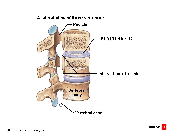 A lateral view of three vertebrae Pedicle Intervertebral disc Intervertebral foramina Vertebral body Vertebral