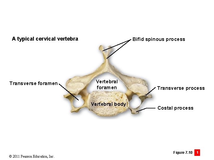 A typical cervical vertebra Transverse foramen Bifid spinous process Vertebral foramen Vertebral body ©