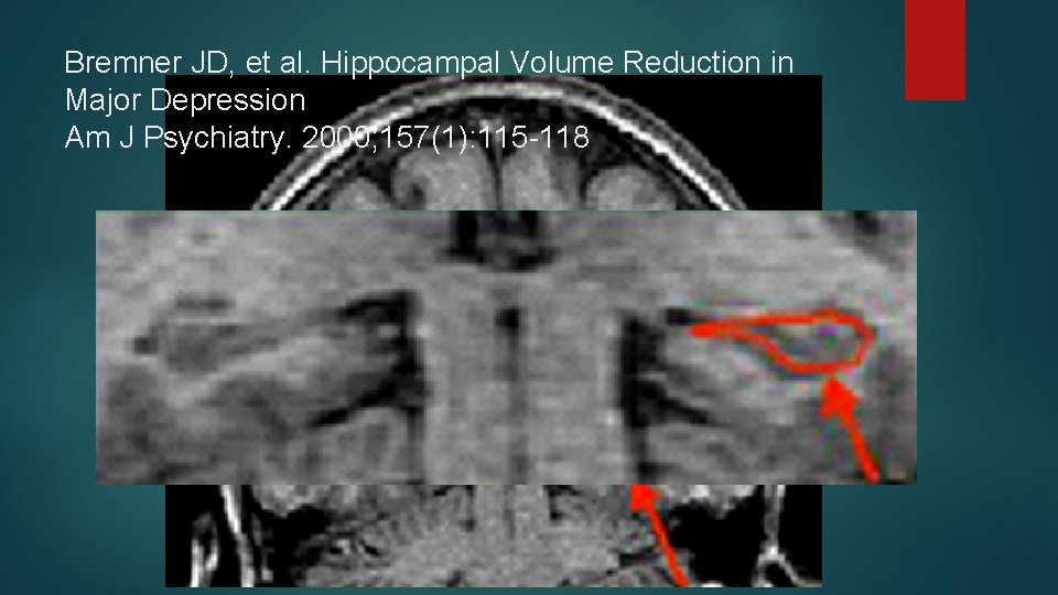 Bremner JD, et al. Hippocampal Volume Reduction in Major Depression Am J Psychiatry. 2000;