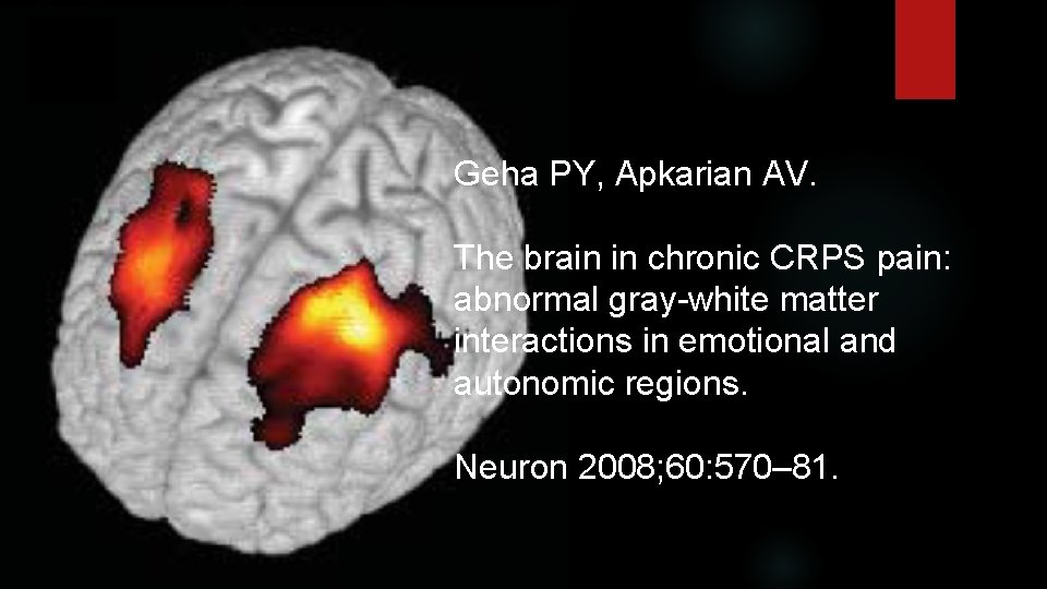 Geha PY, Apkarian AV. The brain in chronic CRPS pain: abnormal gray-white matter interactions