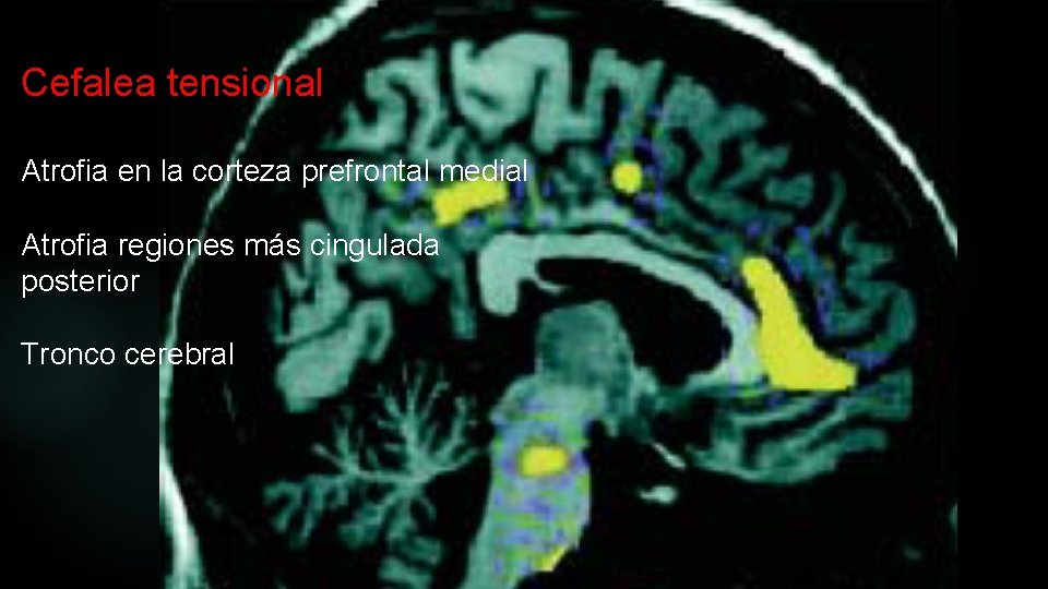 Cefalea tensional Atrofia en la corteza prefrontal medial Atrofia regiones más cingulada posterior Tronco