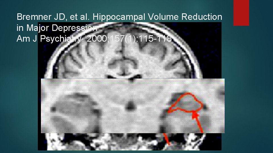 Bremner JD, et al. Hippocampal Volume Reduction in Major Depression Am J Psychiatry. 2000;