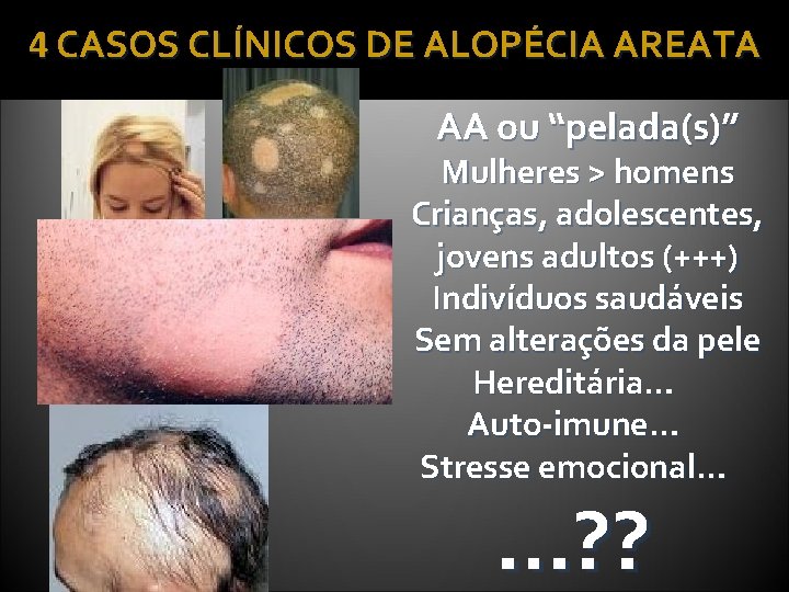 4 CASOS CLÍNICOS DE ALOPÉCIA AREATA AA ou “pelada(s)” Mulheres > homens Crianças, adolescentes,