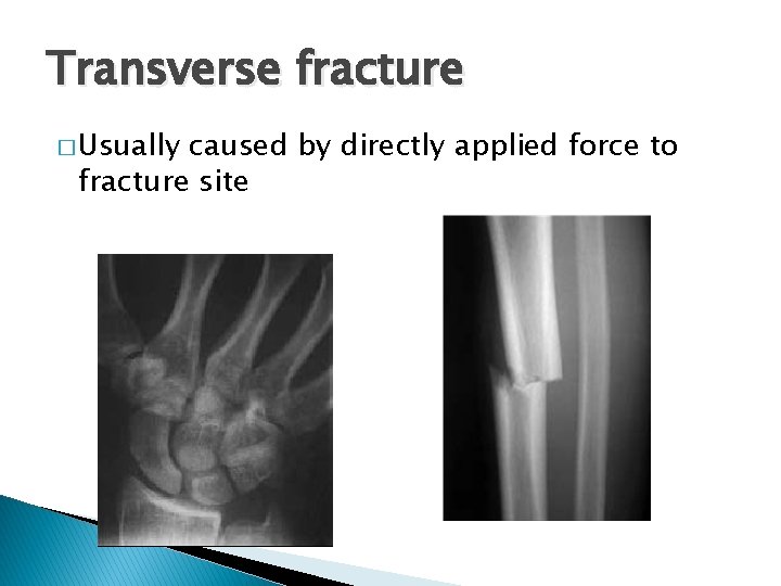 Transverse fracture � Usually caused by directly applied force to fracture site 