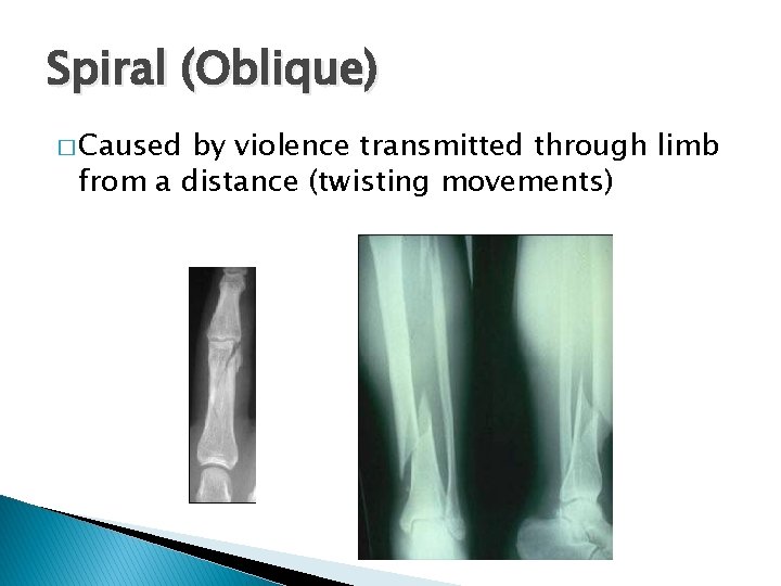 Spiral (Oblique) � Caused by violence transmitted through limb from a distance (twisting movements)