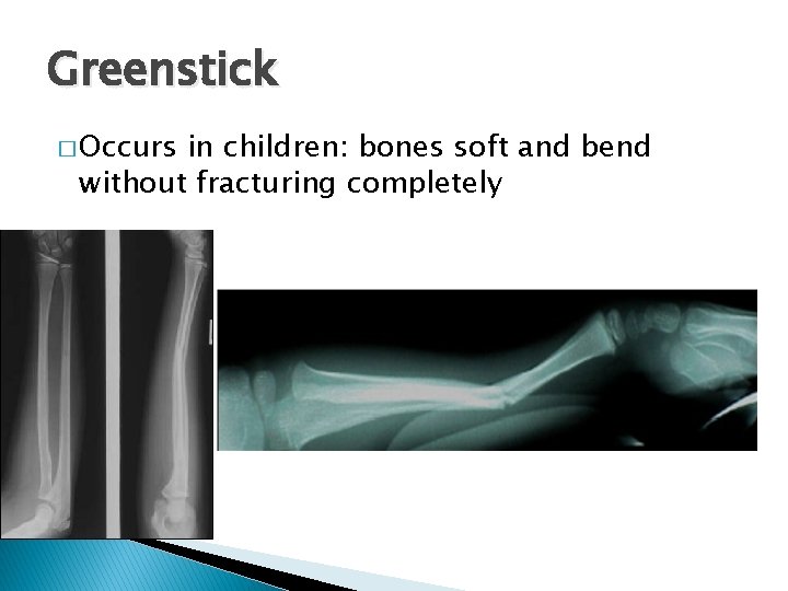Greenstick � Occurs in children: bones soft and bend without fracturing completely 