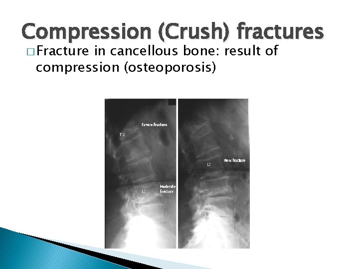 Compression (Crush) fractures � Fracture in cancellous bone: result of compression (osteoporosis) 