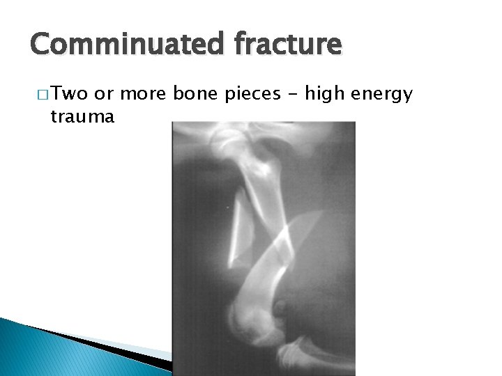 Comminuated fracture � Two or more bone pieces - high energy trauma 