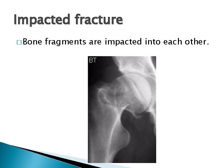 Impacted fracture � Bone fragments are impacted into each other. 