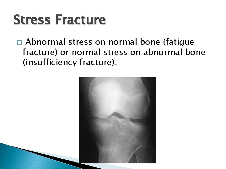 Stress Fracture � Abnormal stress on normal bone (fatigue fracture) or normal stress on