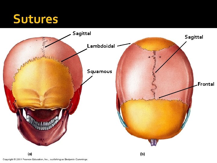 Sutures Sagittal Lambdoidal Squamous Frontal 