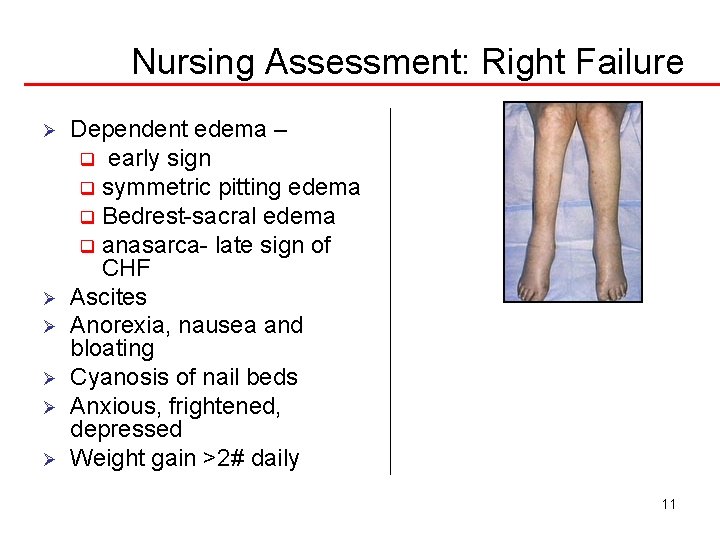 Nursing Assessment: Right Failure Ø Ø Ø Dependent edema – q early sign q