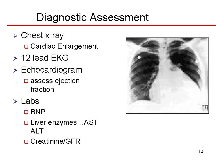 Diagnostic Assessment Ø Chest x-ray q Ø Ø 12 lead EKG Echocardiogram q Ø