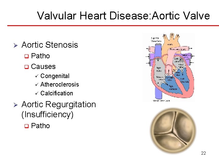 Valvular Heart Disease: Aortic Valve Ø Aortic Stenosis Patho q Causes q Congenital ü
