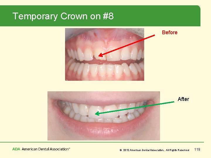 Temporary Crown on #8 Before After © 2012 American Dental Association, All Rights Reserved