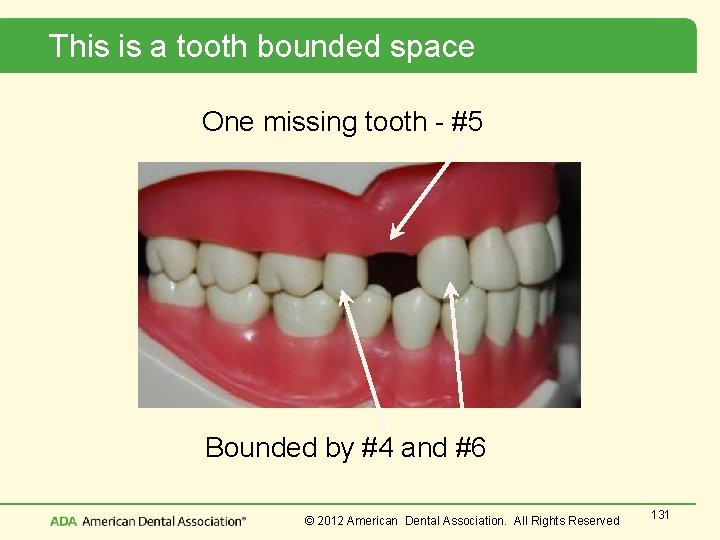 This is a tooth bounded space One missing tooth - #5 Bounded by #4