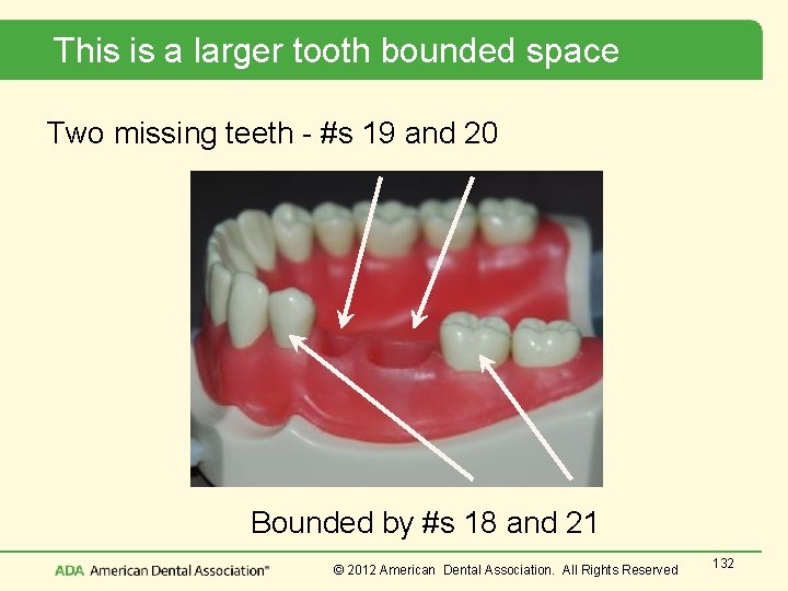 This is a larger tooth bounded space Two missing teeth - #s 19 and