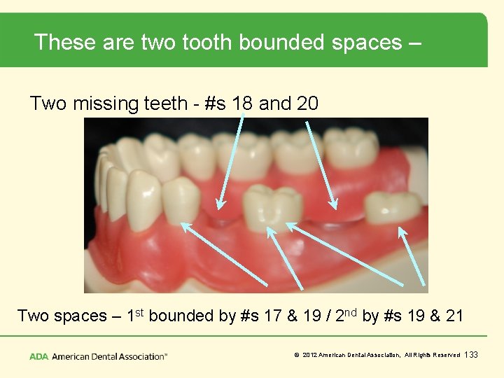 These are two tooth bounded spaces – Two missing teeth - #s 18 and