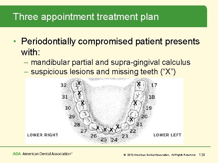 Three appointment treatment plan • Periodontially compromised patient presents with: – mandibular partial and