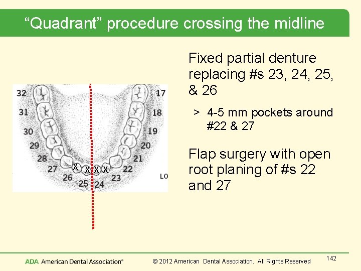 “Quadrant” procedure crossing the midline Fixed partial denture replacing #s 23, 24, 25, &