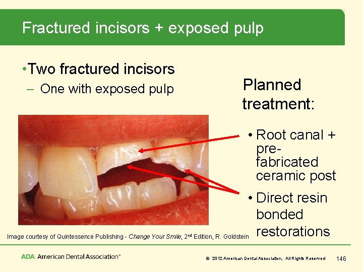 Fractured incisors + exposed pulp • Two fractured incisors Planned treatment: – One with