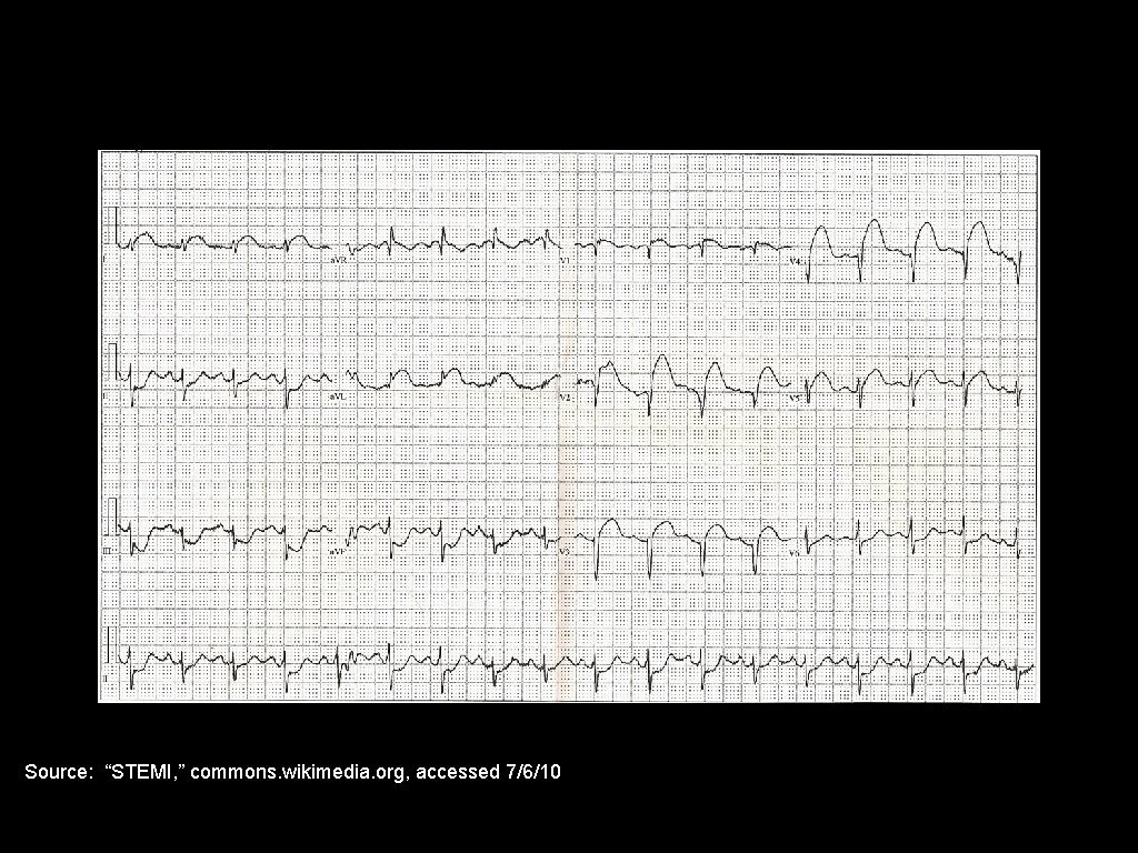 Source: “STEMI, ” commons. wikimedia. org, accessed 7/6/10 