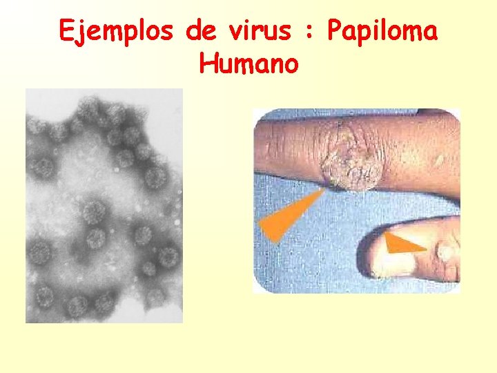 Ejemplos de virus : Papiloma Humano 