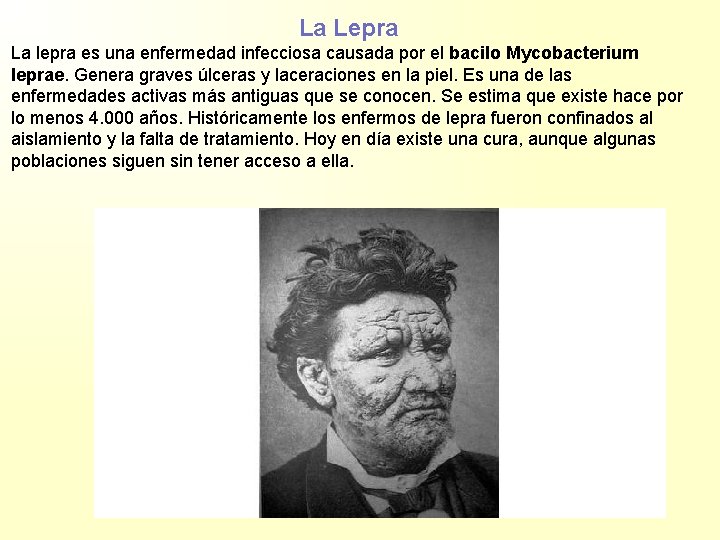 La Lepra La lepra es una enfermedad infecciosa causada por el bacilo Mycobacterium leprae.