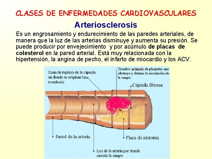 CLASES DE ENFERMEDADES CARDIOVASCULARES Arteriosclerosis Es un engrosamiento y endurecimiento de las paredes arteriales,