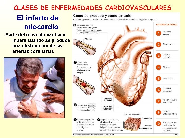 CLASES DE ENFERMEDADES CARDIOVASCULARES El infarto de miocardio Parte del músculo cardíaco muere cuando