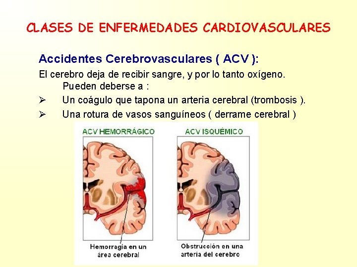 CLASES DE ENFERMEDADES CARDIOVASCULARES Accidentes Cerebrovasculares ( ACV ): El cerebro deja de recibir