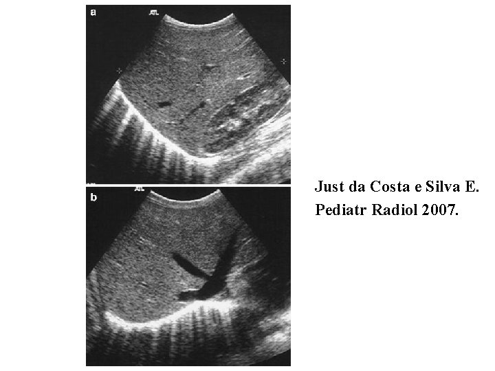 Just da Costa e Silva E. Pediatr Radiol 2007. 