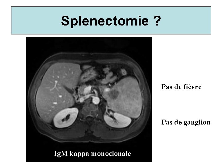 Splenectomie ? Pas de fièvre Pas de ganglion Ig. M kappa monoclonale 