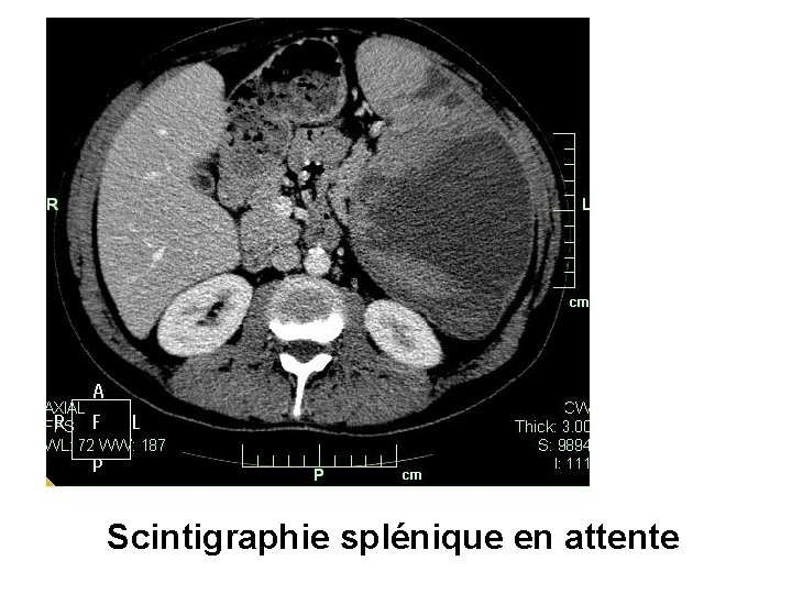 Scintigraphie splénique en attente 