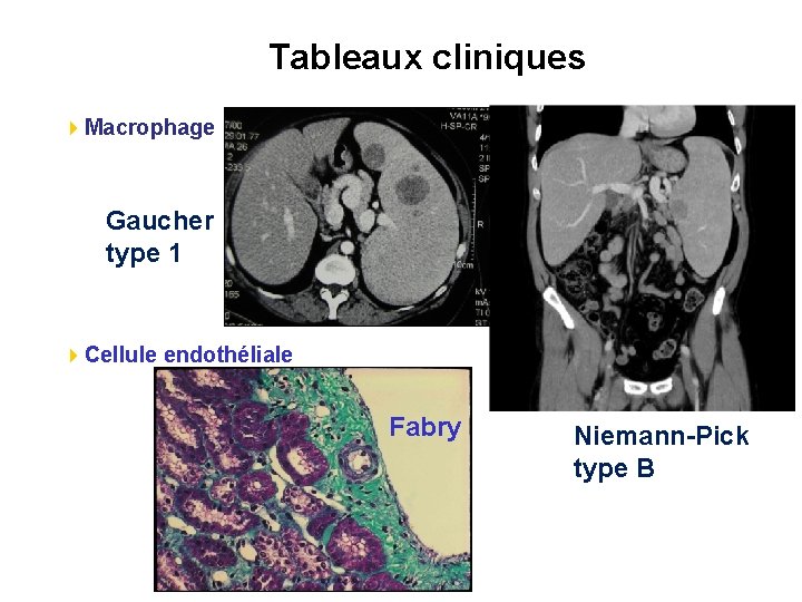 Tableaux cliniques 4 Macrophage Gaucher type 1 4 Cellule endothéliale Fabry Niemann-Pick type B