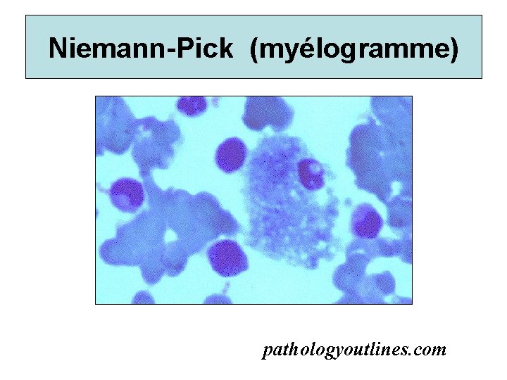 Niemann-Pick (myélogramme) pathologyoutlines. com 