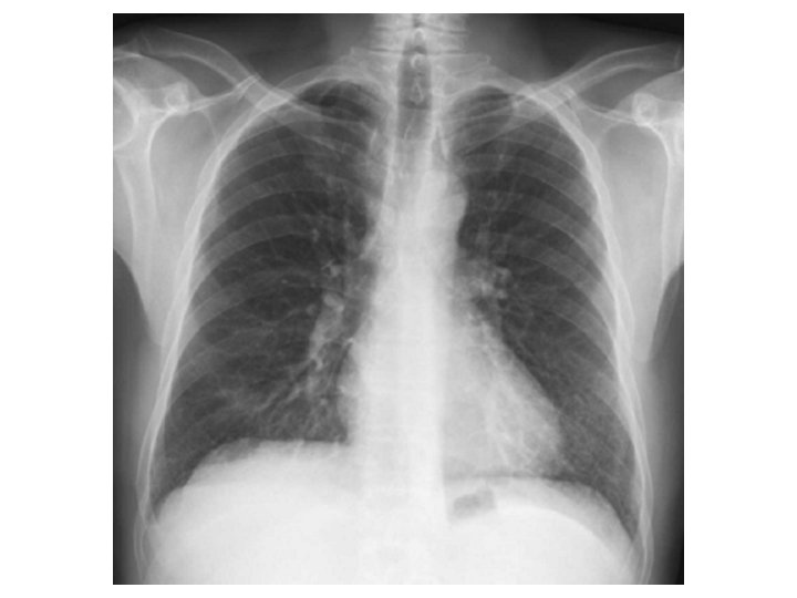 Radiographie thoracique 
