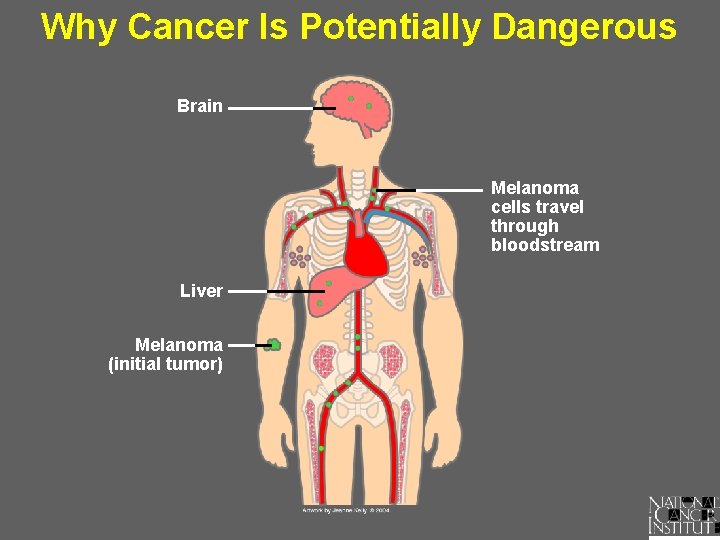 Why Cancer Is Potentially Dangerous Brain Melanoma cells travel through bloodstream Liver Melanoma (initial