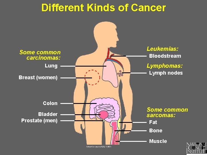 Different Kinds of Cancer Some common carcinomas: Lung Breast (women) Leukemias: Bloodstream Lymphomas: Lymph