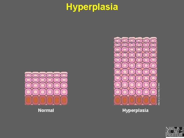 Hyperplasia Normal Hyperplasia 