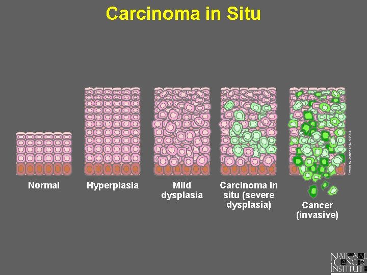 Carcinoma in Situ Normal Hyperplasia Mild dysplasia Carcinoma in situ (severe dysplasia) Cancer (invasive)