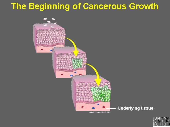 The Beginning of Cancerous Growth Underlying tissue 