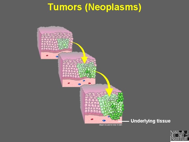 Tumors (Neoplasms) Underlying tissue 