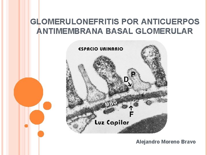 GLOMERULONEFRITIS POR ANTICUERPOS ANTIMEMBRANA BASAL GLOMERULAR Alejandro Moreno Bravo 