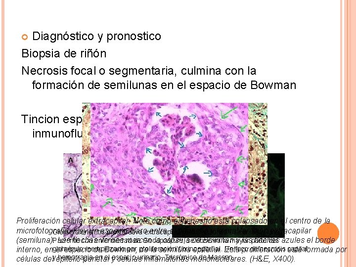 Diagnóstico y pronostico Biopsia de riñón Necrosis focal o segmentaria, culmina con la formación