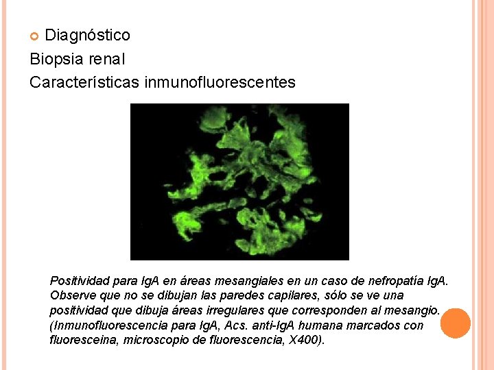 Diagnóstico Biopsia renal Características inmunofluorescentes Positividad para Ig. A en áreas mesangiales en un