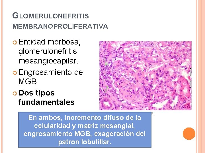 GLOMERULONEFRITIS MEMBRANOPROLIFERATIVA Entidad morbosa, glomerulonefritis mesangiocapilar. Engrosamiento de MGB Dos tipos fundamentales En ambos,