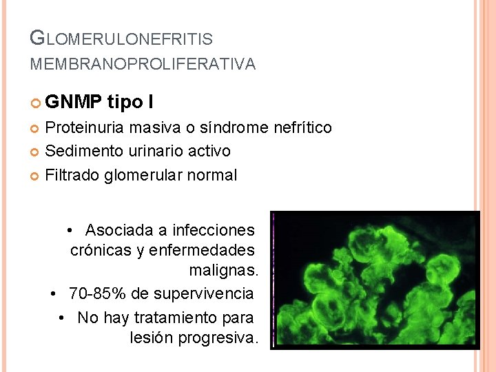 GLOMERULONEFRITIS MEMBRANOPROLIFERATIVA GNMP tipo I Proteinuria masiva o síndrome nefrítico Sedimento urinario activo Filtrado
