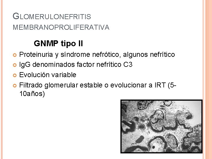 GLOMERULONEFRITIS MEMBRANOPROLIFERATIVA GNMP tipo II Proteinuria y síndrome nefrótico, algunos nefrítico Ig. G denominados