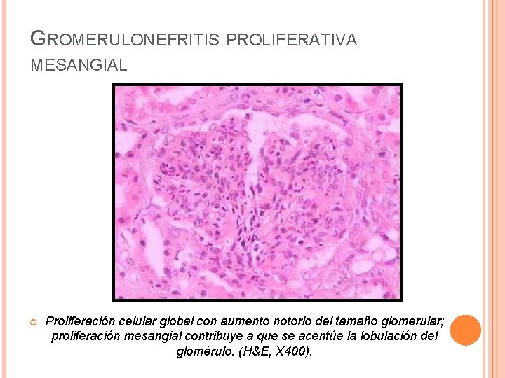 GROMERULONEFRITIS PROLIFERATIVA MESANGIAL Proliferación celular global con aumento notorio del tamaño glomerular; proliferación mesangial